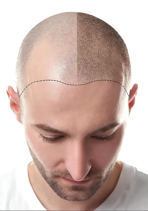 Scalp micropigmentation before and after
